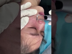 1064nm 532nm सैलून पिकोसेकंड लेजर मशीन त्वचा रंजकता घावों की समस्या के उपचार के लिए