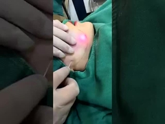 पेशेवर 1470nm डायोड लेजर वसा घटाने की मशीन 2-3 सत्रों में दृश्यमान परिणाम